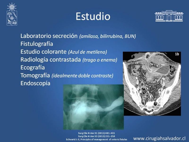 Diapositiva 7 de Fístulas Intestinales