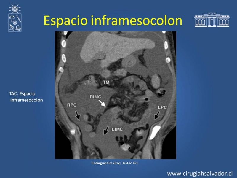 Diapositiva 31 de Anatomía Peritoneal y Retroperitoneal