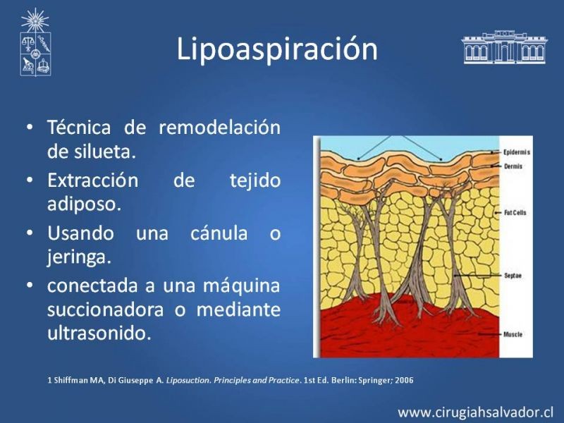 Diapositiva 4 de Liposucción