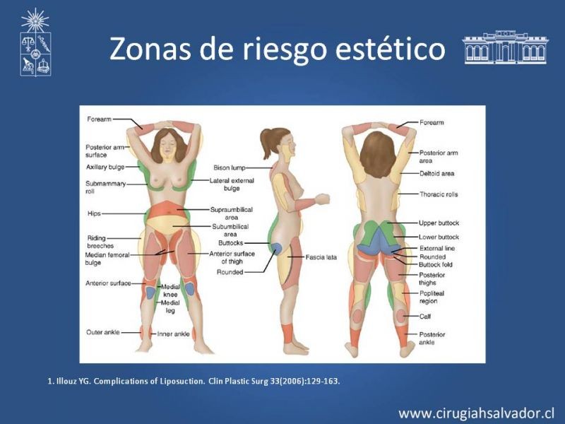 Diapositiva 32 de Liposucción