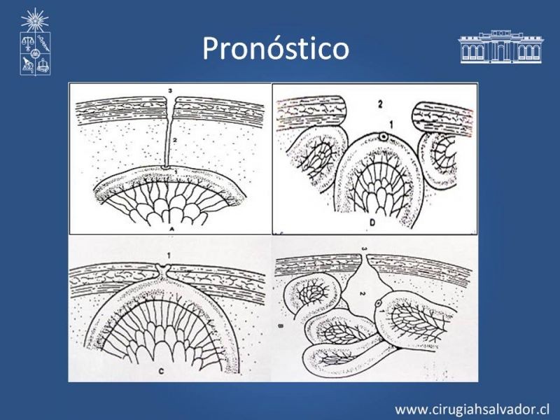 Diapositiva 10 de Fístulas Intestinales