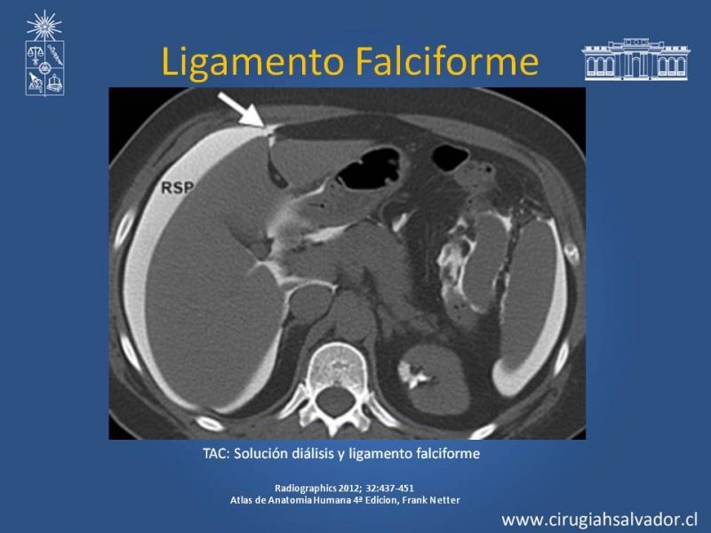 Diapositiva 11 de Anatomía Peritoneal y Retroperitoneal