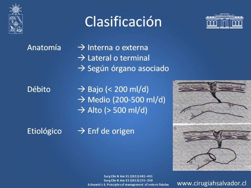 Diapositiva 3 de Fístulas Intestinales