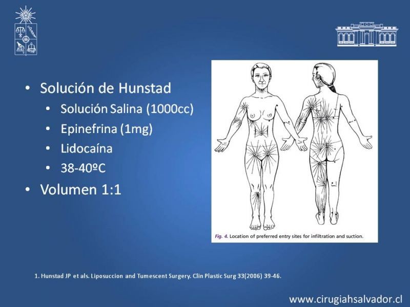 Diapositiva 18 de Liposucción