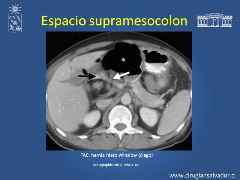Diapositiva 29 de Anatomía Peritoneal y Retroperitoneal