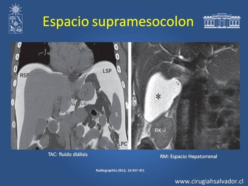 Diapositiva 27 de Anatomía Peritoneal y Retroperitoneal