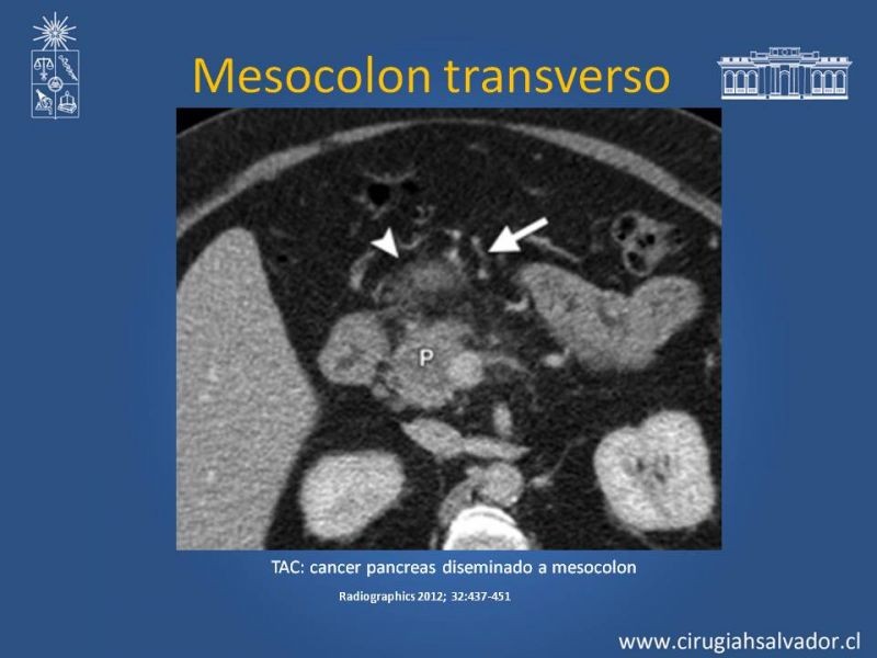 Diapositiva 19 de Anatomía Peritoneal y Retroperitoneal