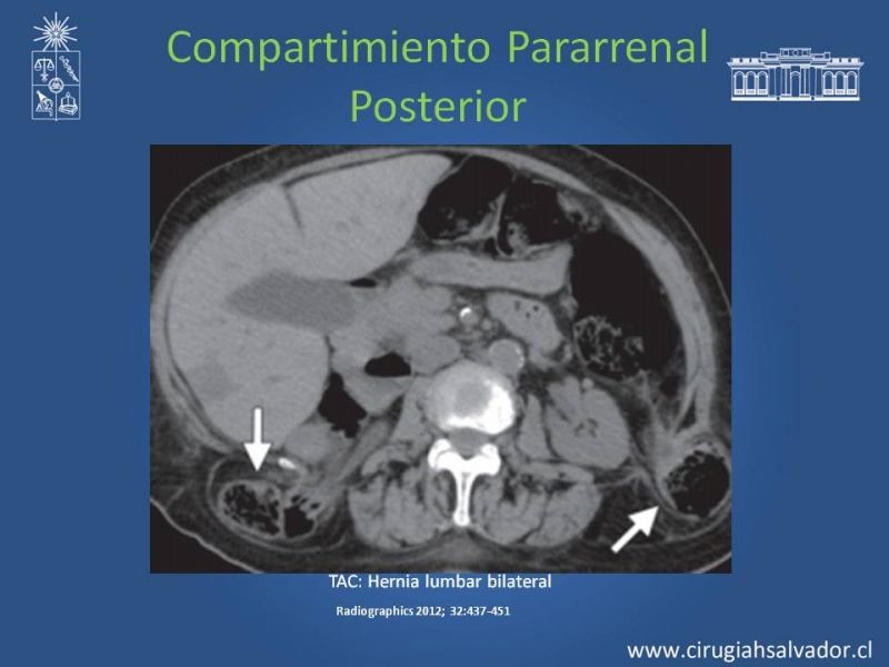 Diapositiva 42 de Anatomía Peritoneal y Retroperitoneal