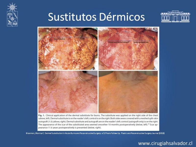 Diapositiva 34 de Sustitutos Dérmicos