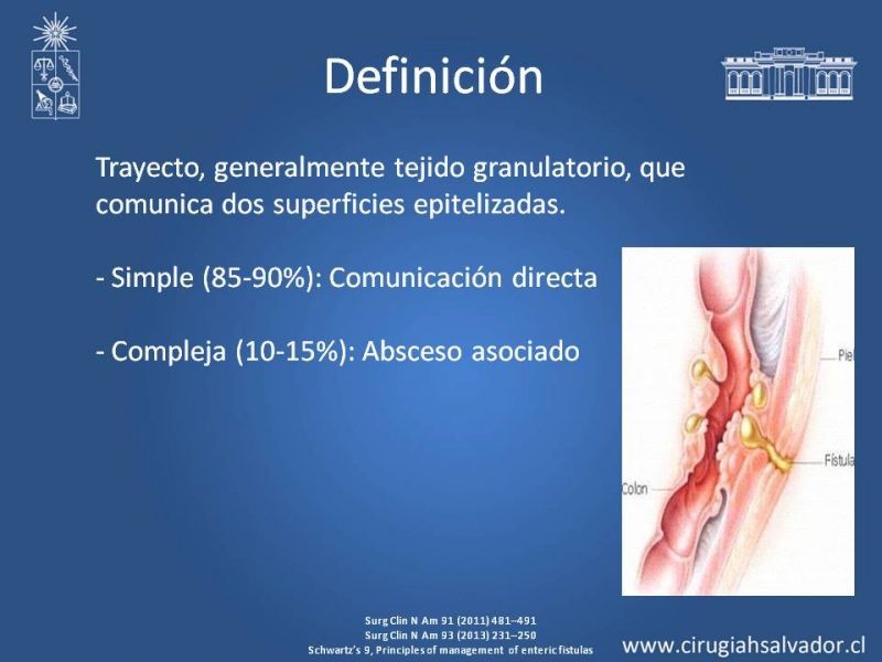 Diapositiva 1 de Fístulas Intestinales