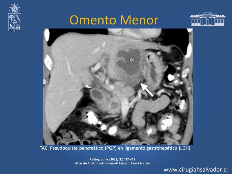 Diapositiva 13 de Anatomía Peritoneal y Retroperitoneal