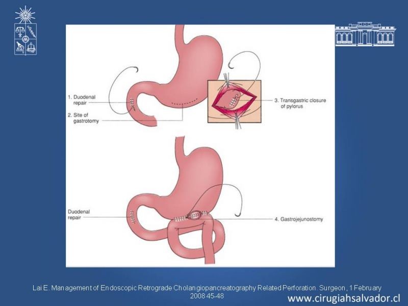 Diapositiva 26 de Perforación post ERCP