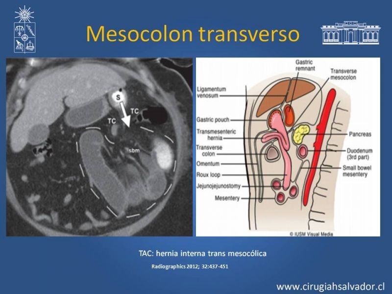 Diapositiva 20 de Anatomía Peritoneal y Retroperitoneal