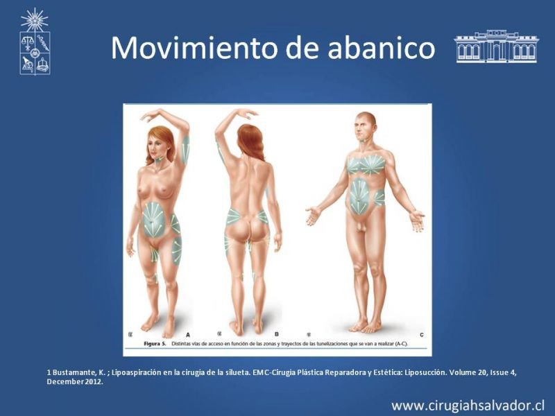 Diapositiva 20 de Liposucción