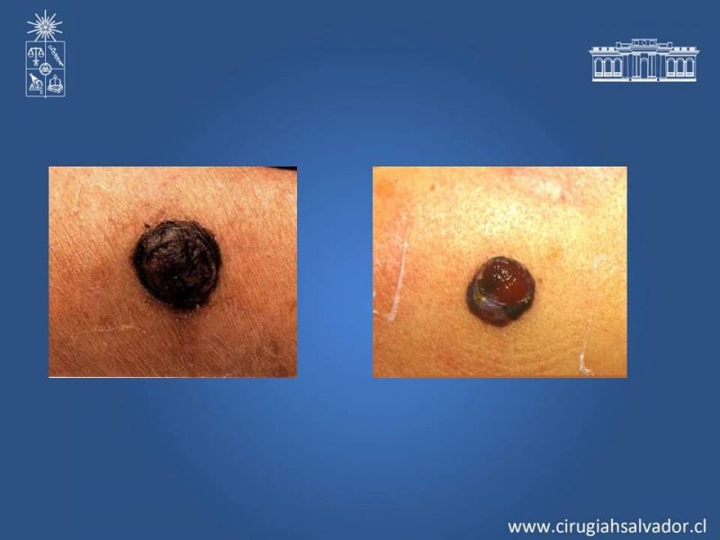 Diapositiva 5 de Manejo quirúrgico del Melanoma