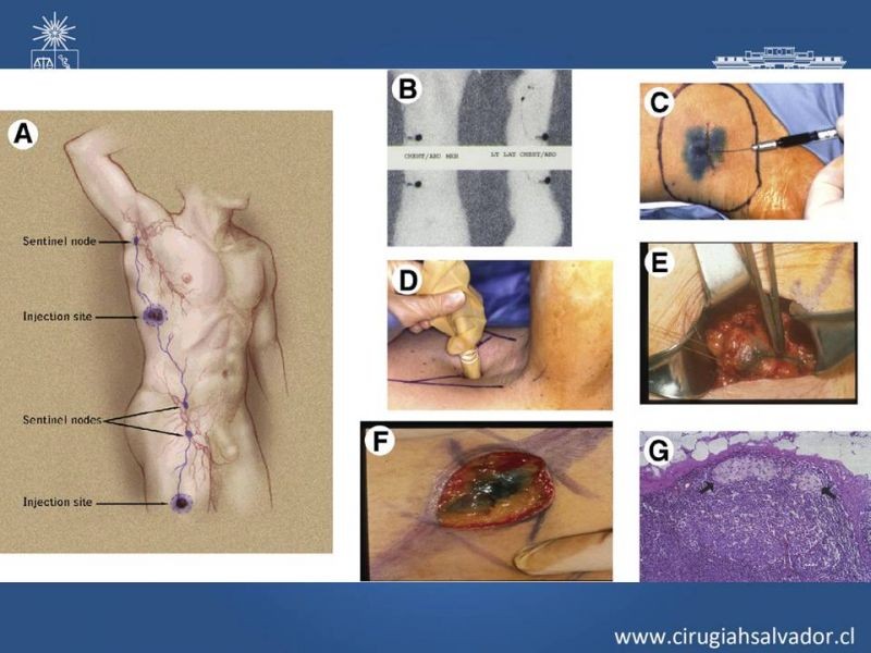 Diapositiva 18 de Manejo quirúrgico del Melanoma