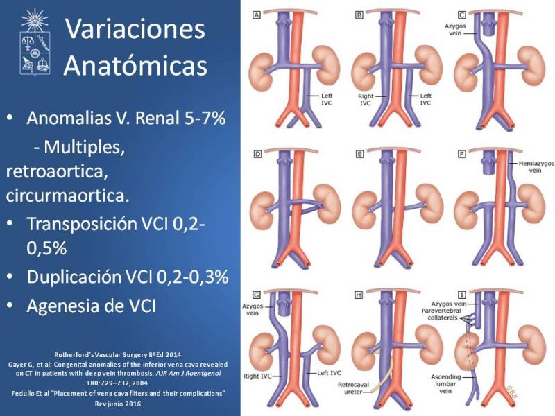 Diapositiva 4 de Filtro de Vena Cava