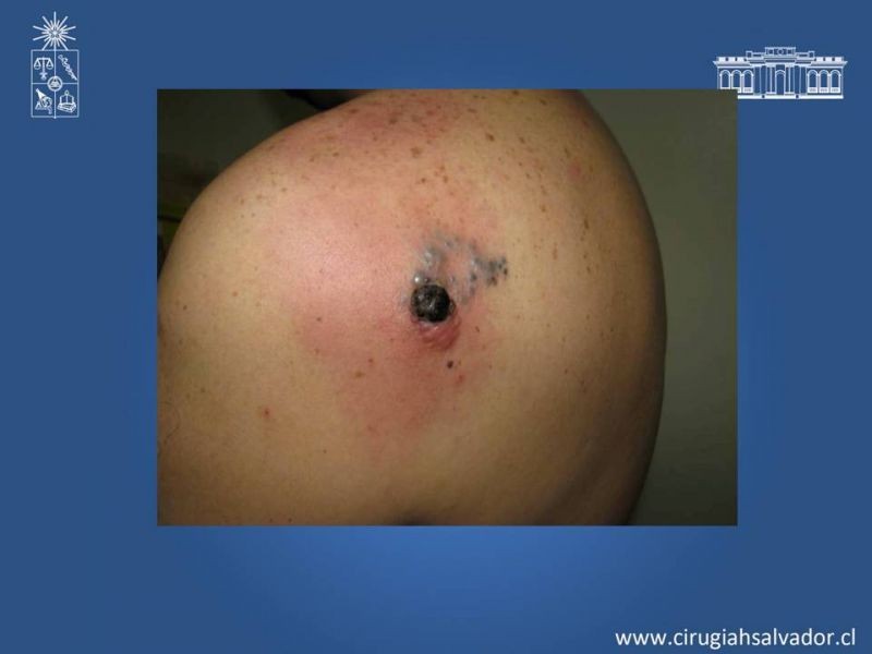 Diapositiva 14 de Manejo quirúrgico del Melanoma