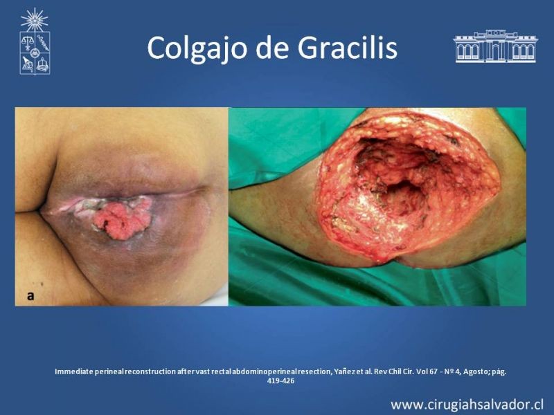 Diapositiva 22 de Reconstrucción Perinea
