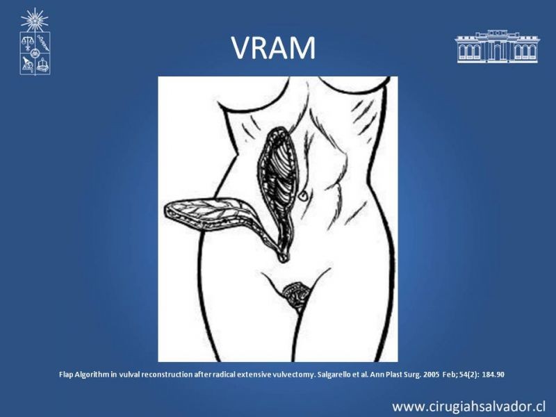 Diapositiva 14 de Reconstrucción Perinea