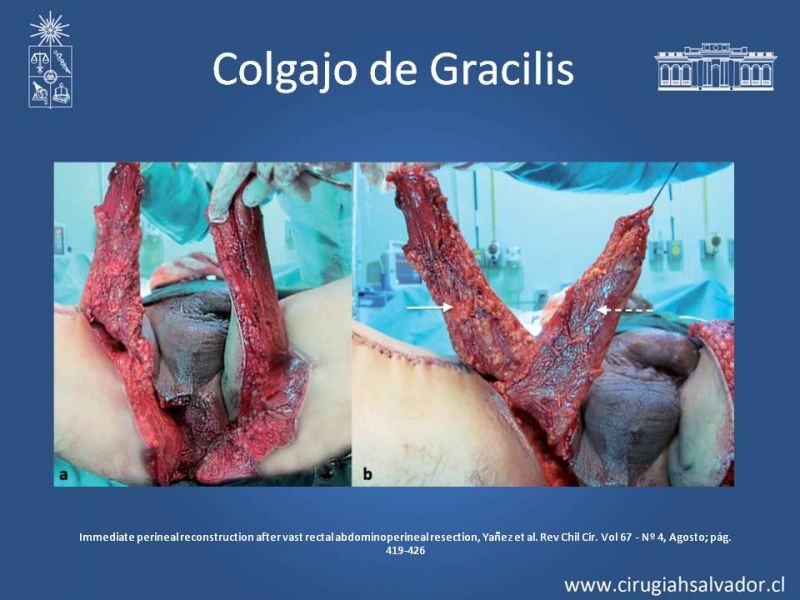 Diapositiva 23 de Reconstrucción Perinea