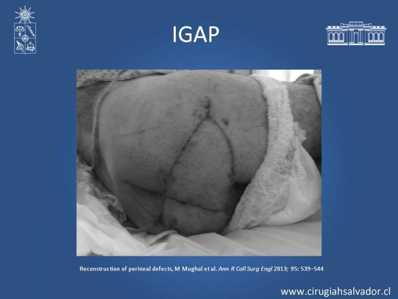 Diapositiva 29 de Reconstrucción Perinea