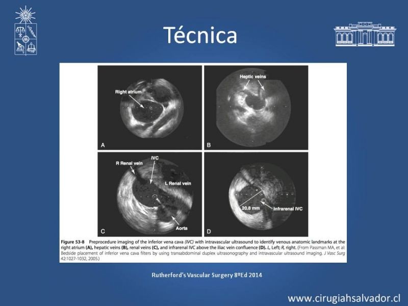 Diapositiva 17 de Filtro de Vena Cava