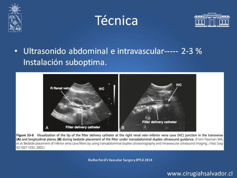 Diapositiva 16 de Filtro de Vena Cava
