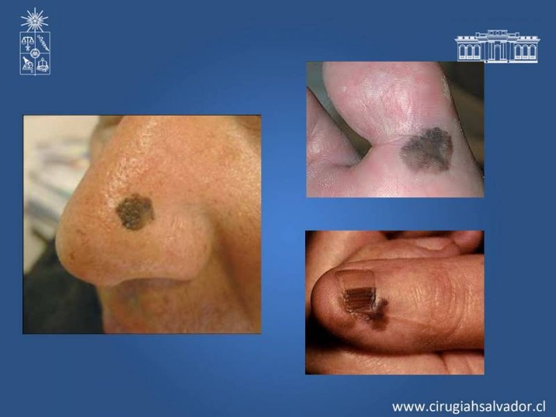 Diapositiva 6 de Manejo quirúrgico del Melanoma