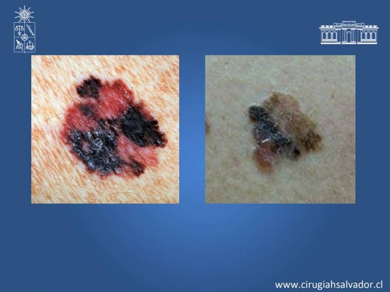 Diapositiva 4 de Manejo quirúrgico del Melanoma