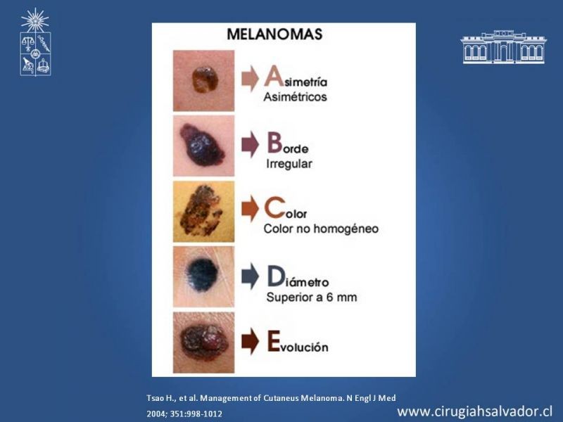 Diapositiva 7 de Manejo quirúrgico del Melanoma