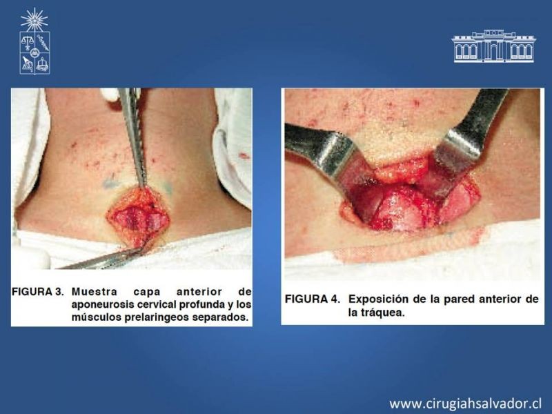 Diapositiva 13 de Traqueostomía