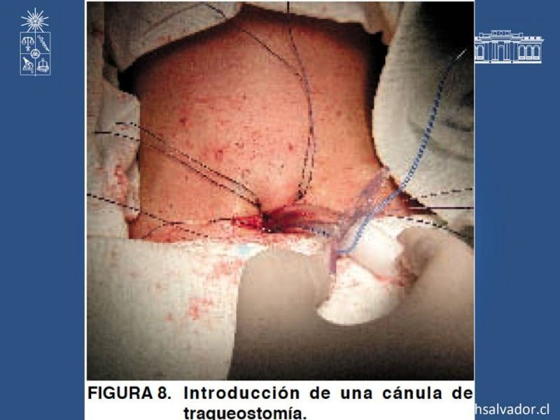 Diapositiva 15 de Traqueostomía