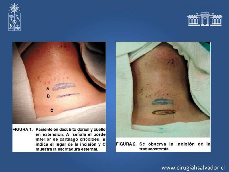 Diapositiva 12 de Traqueostomía