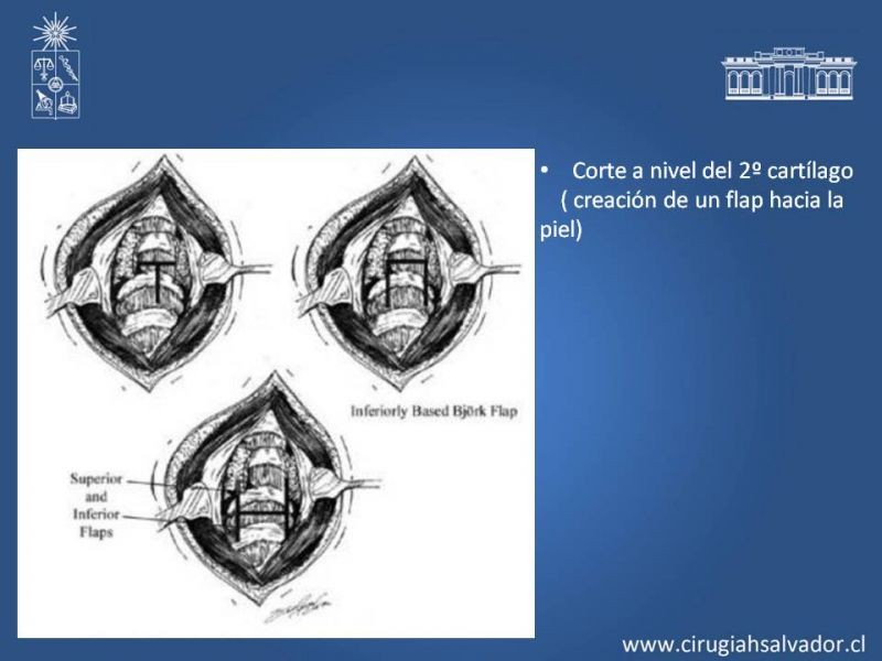 Diapositiva 11 de Traqueostomía