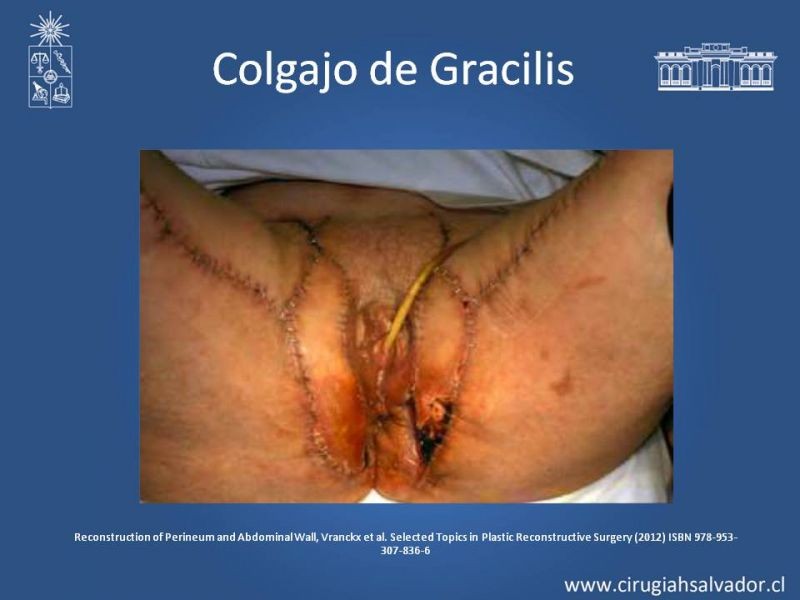 Diapositiva 21 de Reconstrucción Perinea