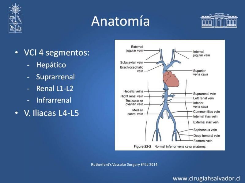 Diapositiva 3 de Filtro de Vena Cava