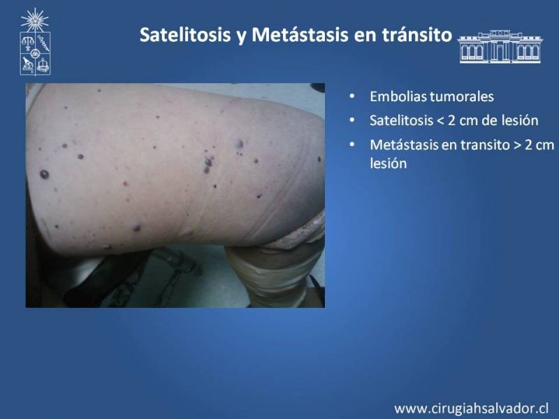 Diapositiva 13 de Manejo quirúrgico del Melanoma