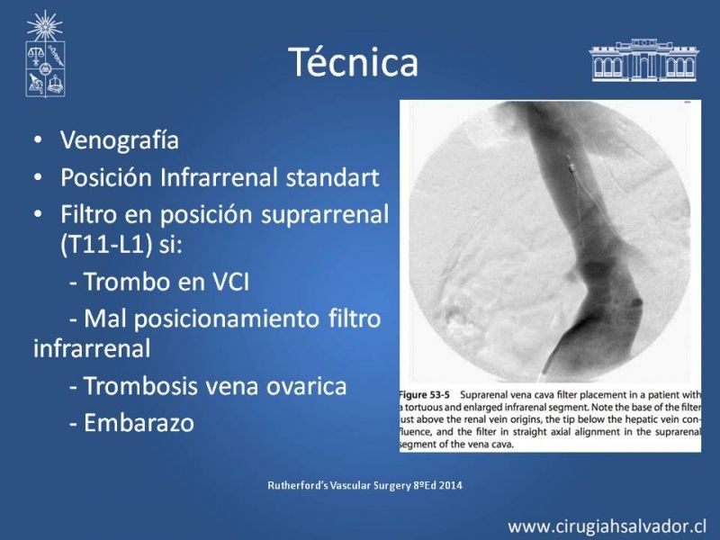 Diapositiva 15 de Filtro de Vena Cava