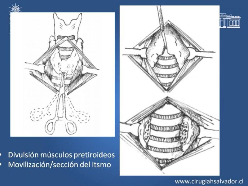 Diapositiva 10 de Traqueostomía