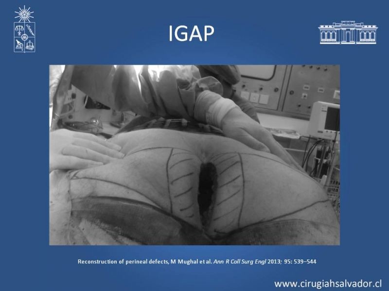 Diapositiva 28 de Reconstrucción Perinea