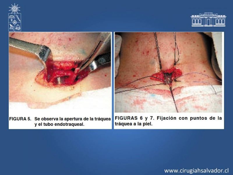 Diapositiva 14 de Traqueostomía