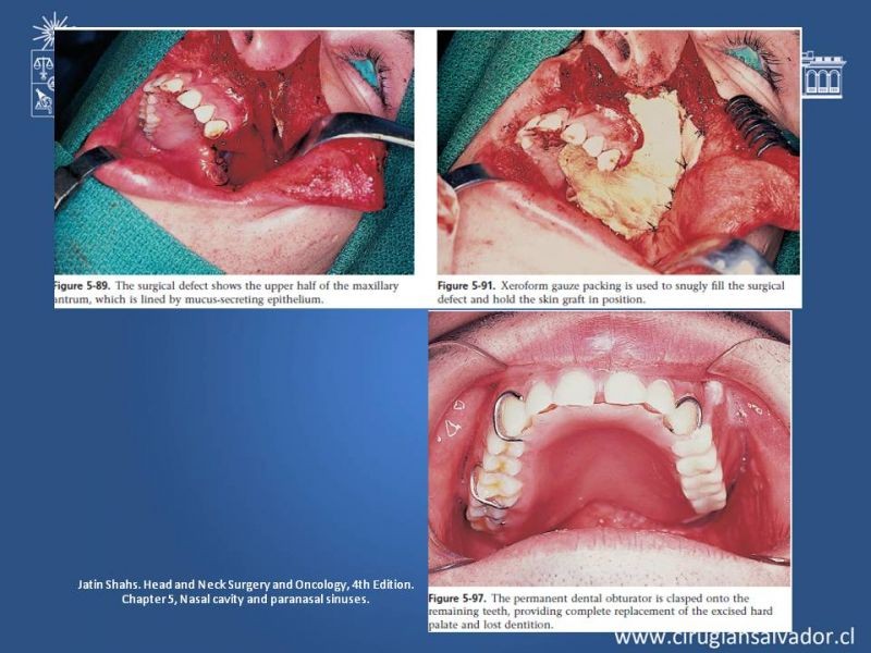 Diapositiva 23 de Tumores de Senos Maxilares