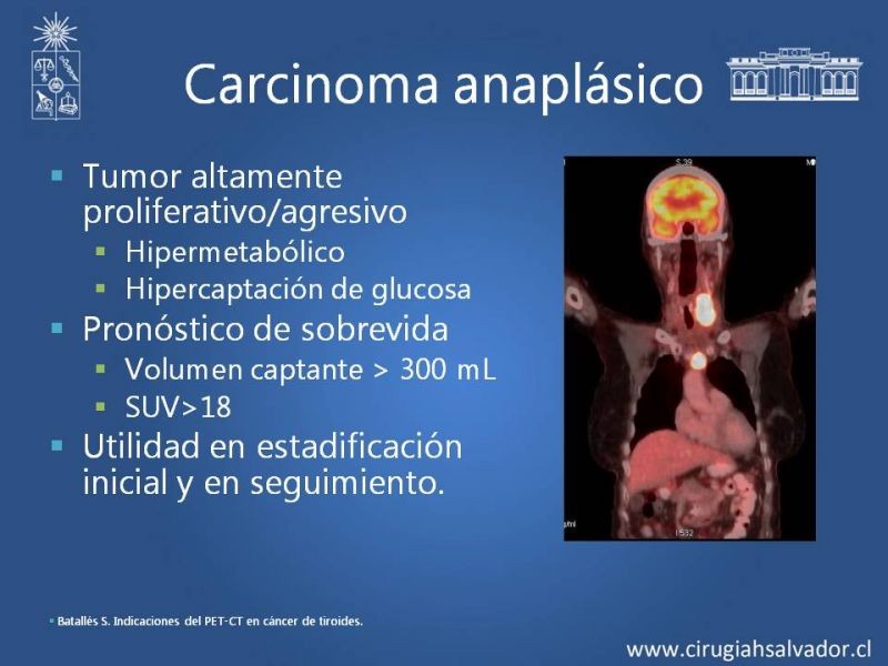 Diapositiva 15 de Utilidad de PET en cáncer de tiroides