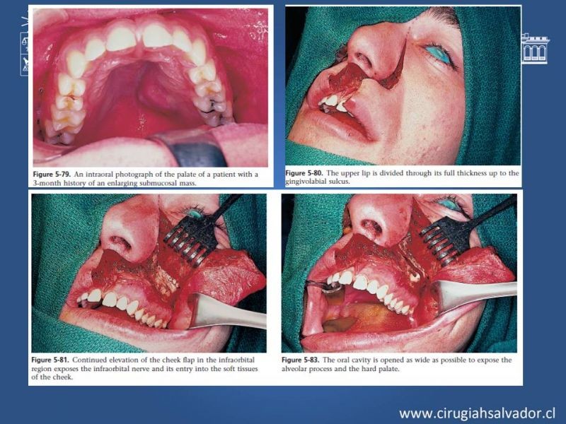 Diapositiva 21 de Tumores de Senos Maxilares