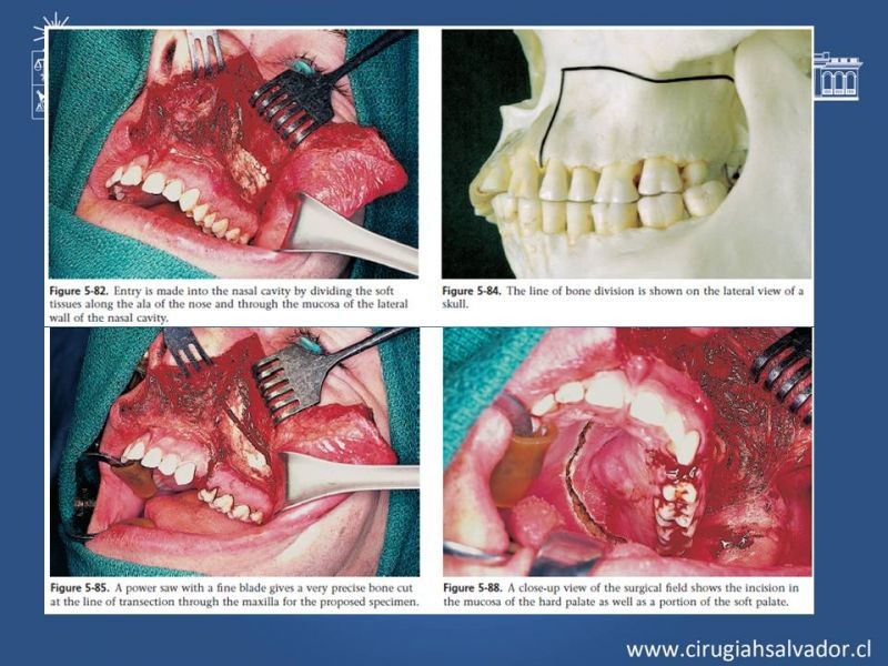Diapositiva 22 de Tumores de Senos Maxilares