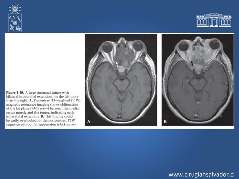 Diapositiva 18 de Tumores de Senos Maxilares