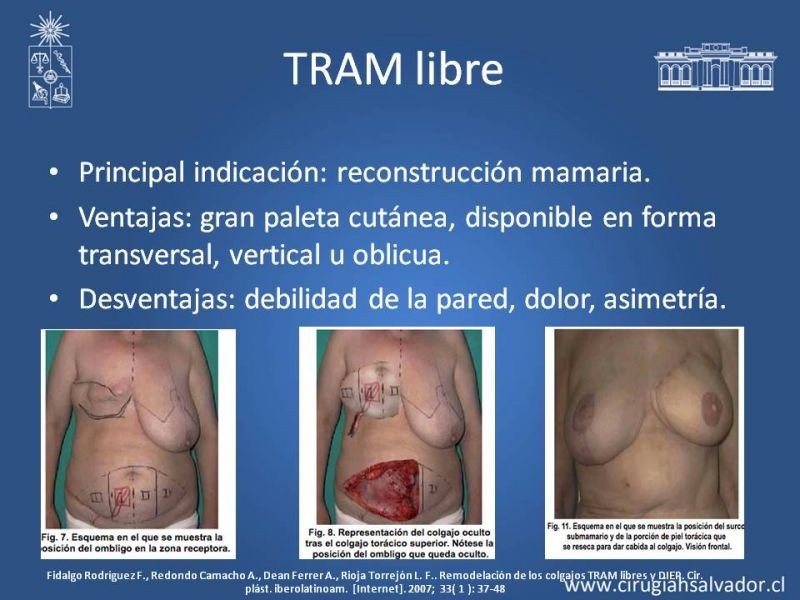 Diapositiva 13 de Colgajos Microquirúrgicos