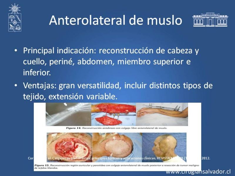 Diapositiva 15 de Colgajos Microquirúrgicos