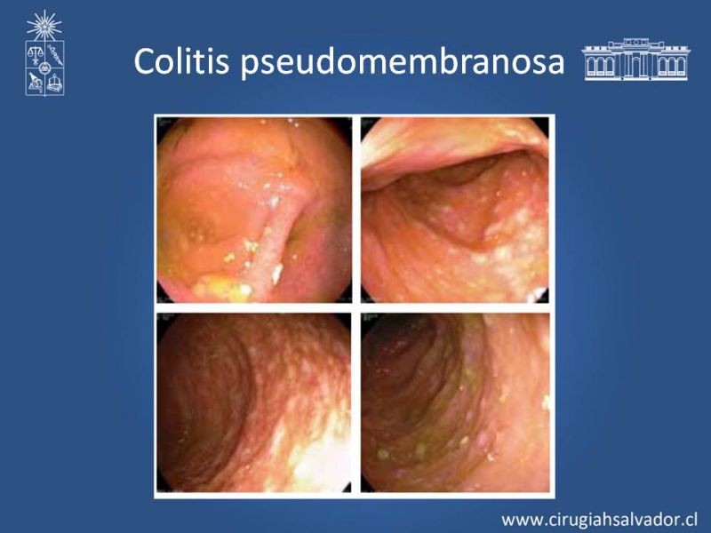 Diapositiva 8 de Diarrea por Clostridium Difficile
